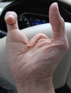 hand with only 1 finger and thumb limb difference