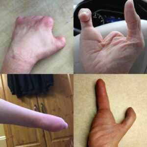 Pictures of hands with a Limb Difference (missing fingers/ parts of hand) which would benefit from the Limb Difference aid.