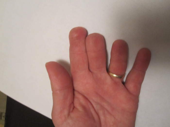 hand with amputated tops of fingers