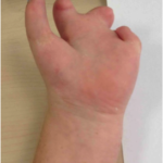 hand with limb difference