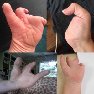hands with limb difference effecting the hand or fingers
