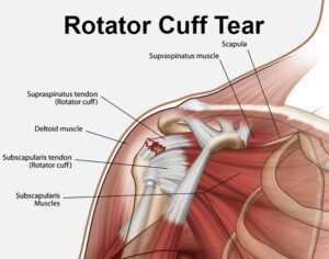 diagram showing a rotator cuff tear