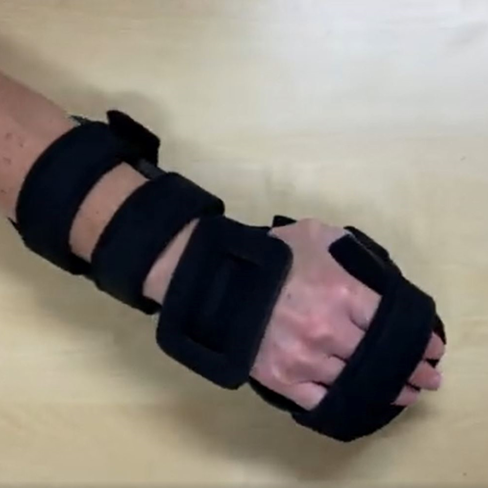 Resting hand splint video